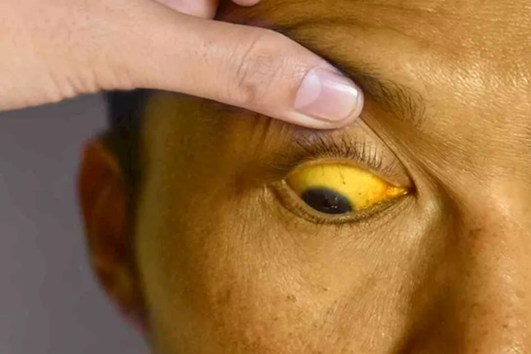 اصفرار الجلد الخفيف- متى يكون مؤشرًا على مشكلة في الكبد؟ 