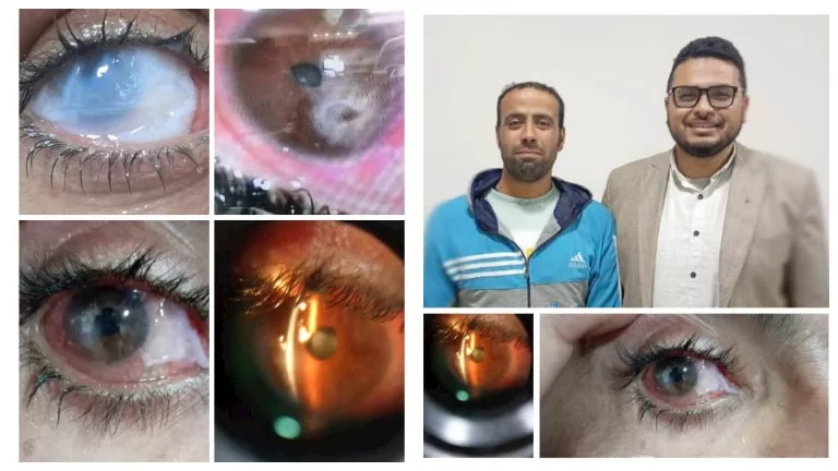 من “خيال اليد” لـ 6/9.. إنقاذ عين شاب “انفجرت ذاتيًا” ببني سويف