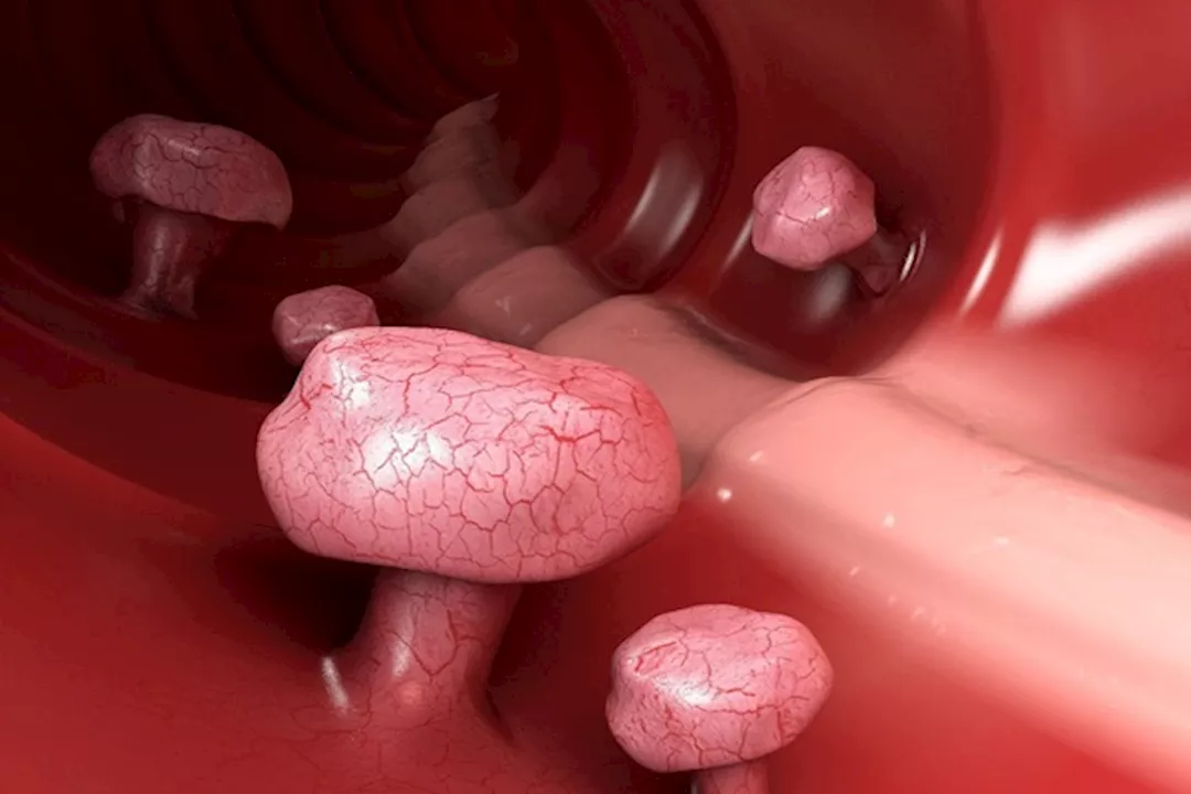 زوائد اللحمية في القولون