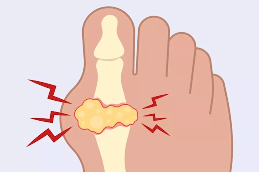 النقرس والرياضة- 3 تمارين لخفض حمض اليوريك في 90 يومًا