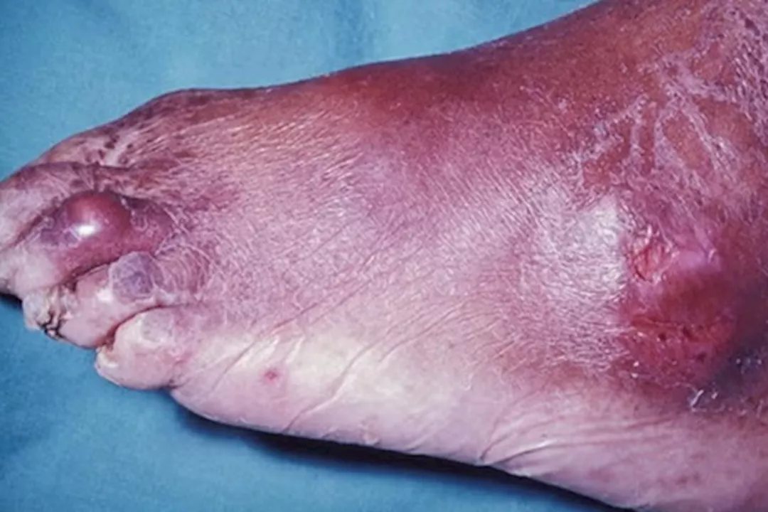 انتبه لبشرتك- 5 أعراض لمرض النقرس تظهر عليها