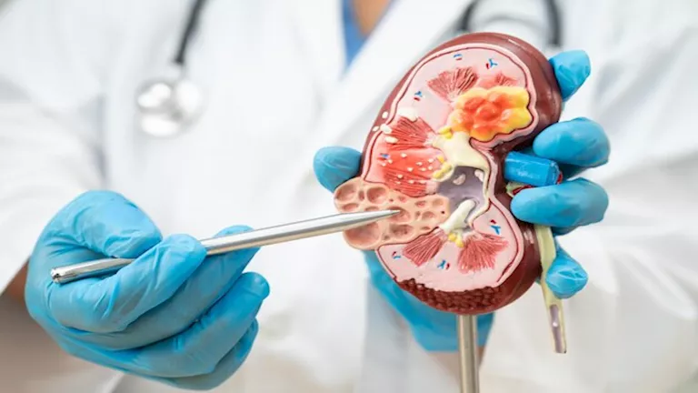 كيف يؤثر الملح والبروتين الزائد على صحة الكلى؟ 