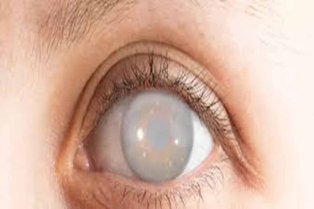 إعتام عدسة العين مقابل الجلوكوما.. ما الفرق بينهما؟