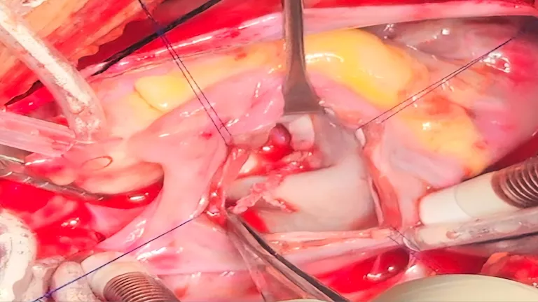 قصر العيني: إنقاذ قلب طفل من ورم نادر شديد الخطورة دون المساس بصمام ال