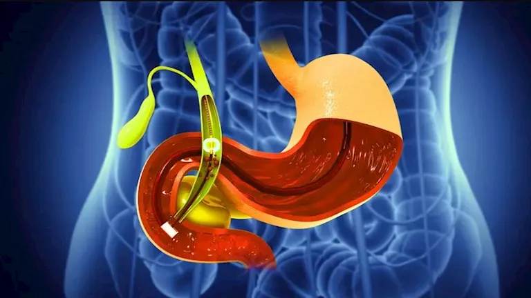 في رمضان.. 6 طرق فعالة للحفاظ على صحة المرارة 