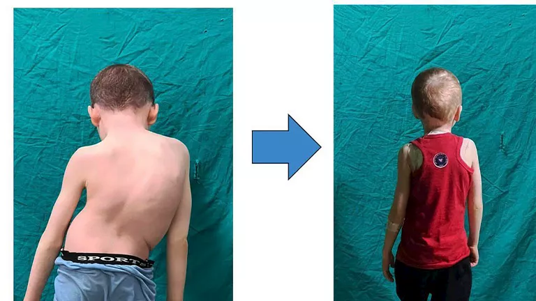 فريق طبي ينجح في تصحيح خطير بالعمود الفقري لطفل بأسيوط