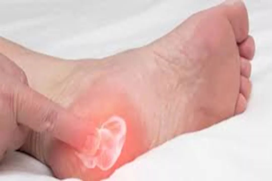 أسباب مسامير القدم العظمية وكيفية الوقاية منها.. طبيب يوضح 
