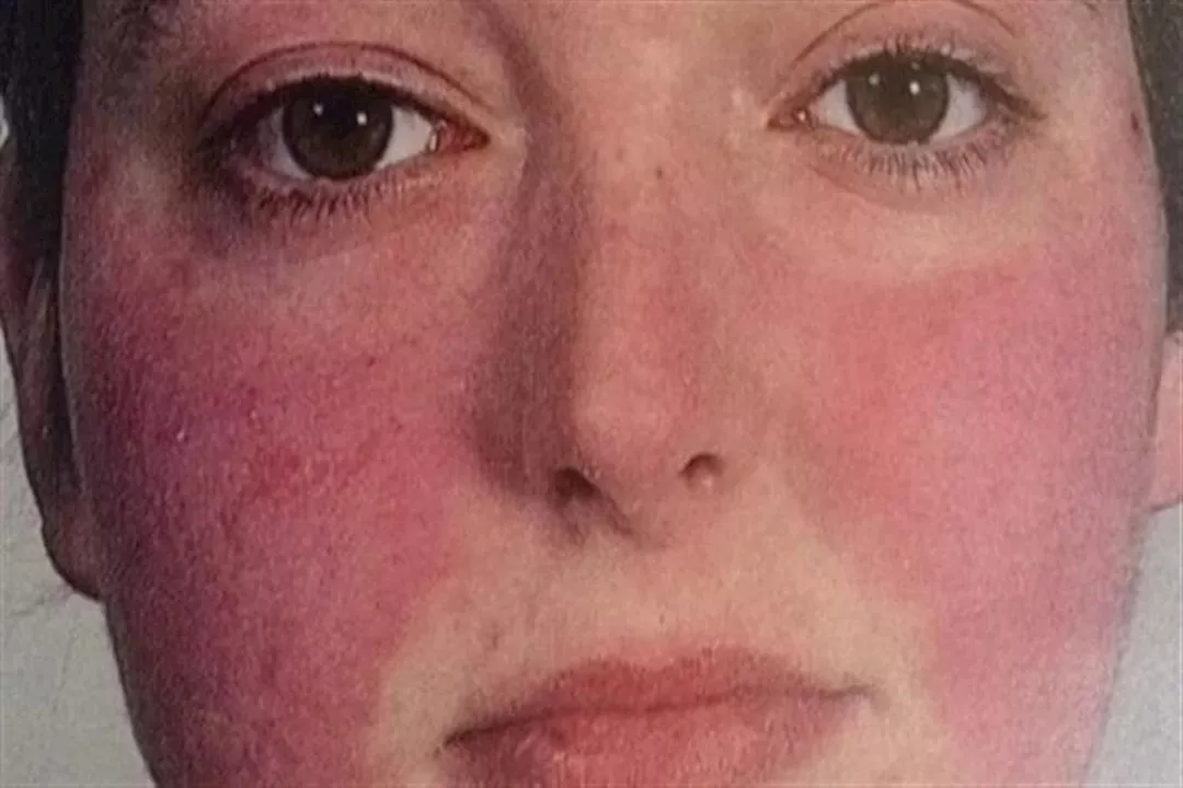 متلازمة احمرار الوجه بسبب المضاد الحيوي فانكومايسين.. ماذا يحدث؟ 