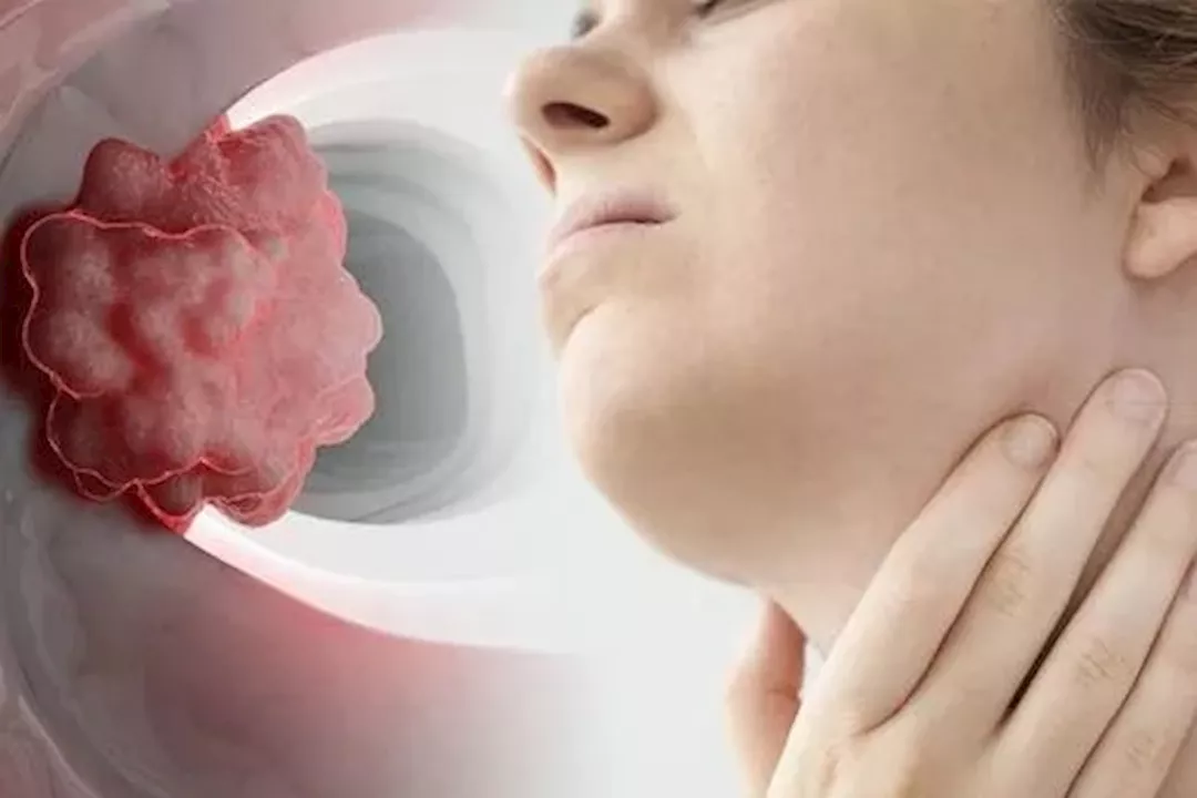 Bowel-cancer-might-lead-to-a-swollen-neck-1432976