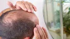 وداعا للصلع.. مستحضر موضعي يعزز كثافة الشعر في 6 أشهر