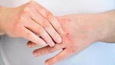 حتى مع النظافة اليومية.. لماذا تظهر الالتهابات الجلدية القيحية؟