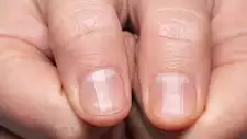 احذر.. علامة على الأظافر تدل على الإصابة بسرطان خبيث