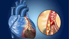 علامات خفية لـ تمدد الأوعية الدموية في الدماغ.. وهذه الفئة الأكثر عرضة
