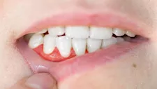 أمراض اللثة قد تزيد من مخاطر مرضى الكلى المزمن
