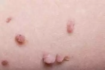 هل يزيد فيروس الورم الحليمي خطر الإصابة بعدة أنواع من السرطان؟