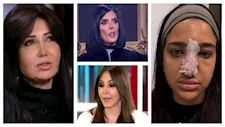بعد أزمة كنزي مدبولي مع الفيلر.. 10 نجمات تعرضن للتشوه بسبب عمليات التجميل