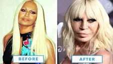  10 صور- نجوم عالميين تغيرت ملامحهم بعد عمليات تجميل من بينهم مادونا وميجان