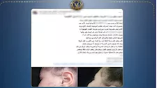 مدرسة تضرب طفلة بالوجه والبطن وتبرر فعلتها بإصابتها بفرط الحركة بالإسكندرية