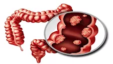 5 أسباب مقلقة تفسر ارتفاع معدلات الإصابة بسرطان الأمعاء