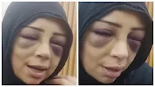 "وشي اتشوّه".. فتاة بورسعيد تكشف تفاصيل اعتداء خطيبها السابق عليها (صور)