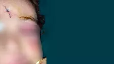 إنقاذ طفل نهشه كلب شرس في المنيا.. وفريق طبي يعيد بناء ملامح وجهه