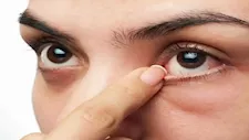  هل يسبب فرك العينين مضاعفات خطيرة؟