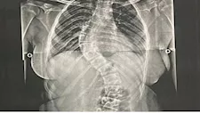 أعادت لها القدرة على الحركة.. مستشفى جامعة الأزهر بأسيوط ينجح في جراحة معقدة لطفلة