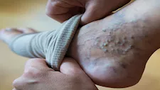 ما أسباب زيادة خطر الإصابة بـ دوالي الساقين لدى النساء؟