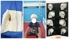 نجاح استخراج رصاصة من مخ طفل عمره 7 سنوات بسوهاج