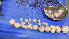 أنهت آلام عام ونصف.. استئصال 21 ورمًا ليفيًا من رحم سيدة بكفر الشيخ