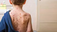 هل يمكن الإصابة بجدري الماء أكثر من مرة؟ 