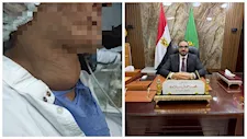 "ورم ضخم وصعوبة في التنفس".. نجاح جراحة دقيقة لسيدة خمسينية بالفيوم