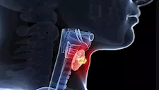 كيف تكتشف إصابتك بالتهاب الغدة الدرقية؟.. احذر 10 أعراض