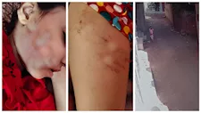 15 غرزة في الوجه.. كلب ضال يهاجم طفلة أثناء ذهابها للدرس بالمنوفية- صور