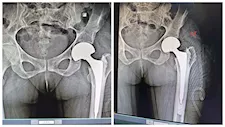 لأول مرة.. مستشفى الفكرية المركزي ينجح في استبدال مفصل فخذ لمريضة تعاني قصورًا بالقلب