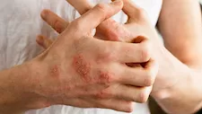كيفية علاج الإكزيما في اليد؟.. 5 طرق لتخفيف الأعراض 