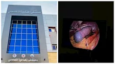 لأول مرة.. مستشفى إهناسيا التخصصي يجري استئصال الطحال بالمنظار لمريضة 59 عامًا