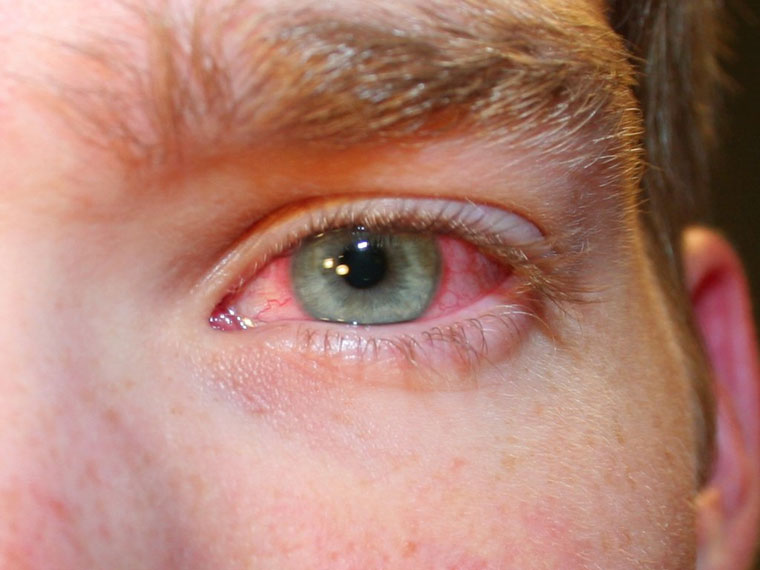 احمرار العين قد يُشير إلى الإصابة بالتهاب الغشاء ا