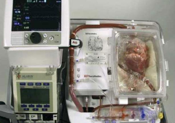 استخدم الجراحون جهاز "القلب في صندوق" لإنعاش القلب