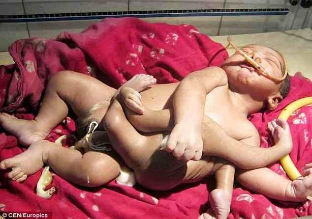 ولادة طفل بأربعة أرجل وأربعة أذرع يثير الرعب