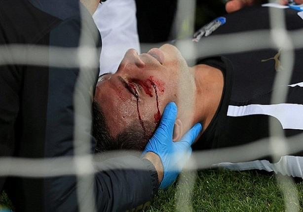 إصابة دموية للاعب نيوكاسل بالدوري الإنجليزي