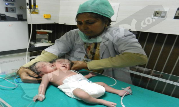 بالفيديو والصور.. ولادة طفلة بجسد واحد ورأسين في ا