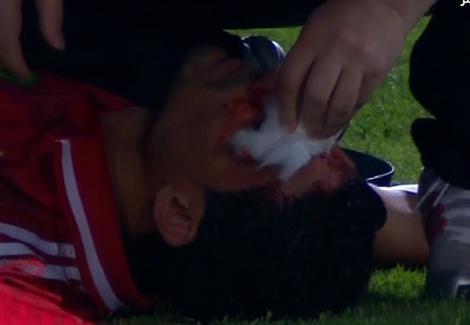 إصابة محمد نجيب بشرخ في الجمجمة