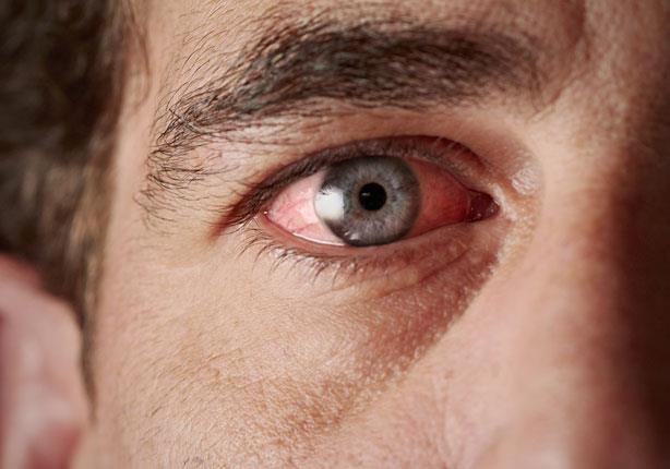 العين قد تُنبئ مبكرا بمرض الزهايمر