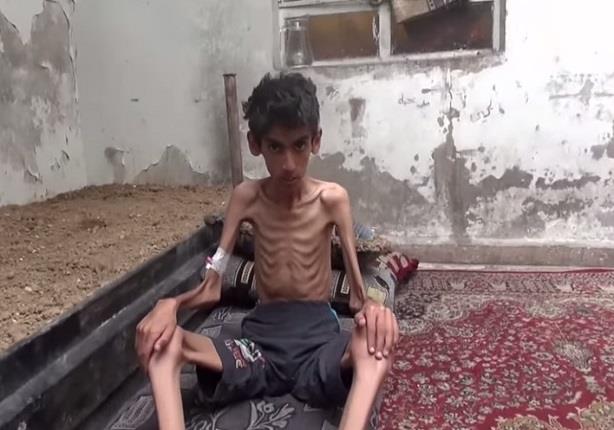 طفل سوري يتحول إلى هيكل عظمي