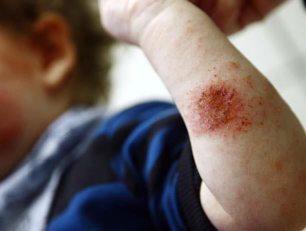 الترطيب يمنع تهيج بشرة طفلك المصاب بالتهاب الجلد