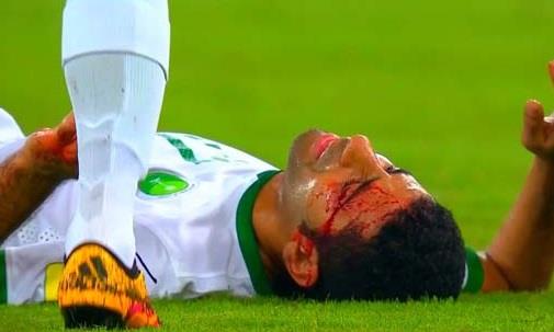 إصابة دموية لنجم المنتخب السعودي