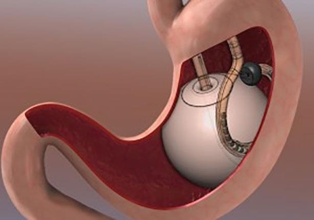 الكبسولة المملؤة بالغاز يتم زرعها فى المعدة بواسطة