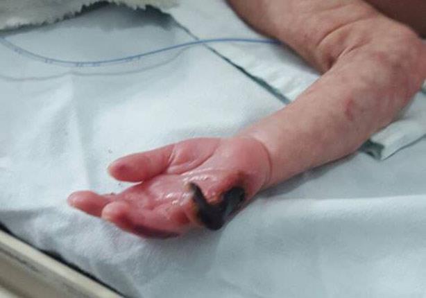 حرق إصبع مولود بحضانة مستشفى بركة السبع في المنوفي