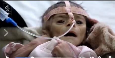 معاناة أطفال اليمن